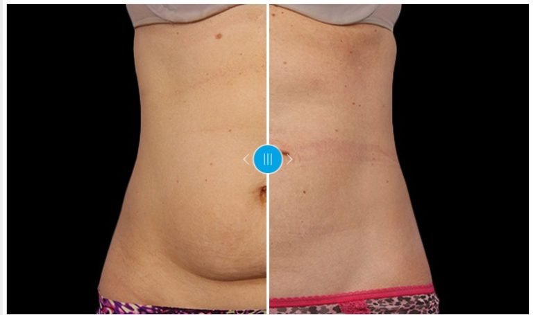 Coolsculpting For Post-Pregnancy Body Transformation In Los Angeles