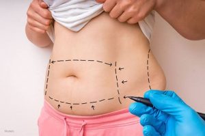 Best Plastic Surgeons in Sydney for Tummy Tuck (Abdominoplasty)